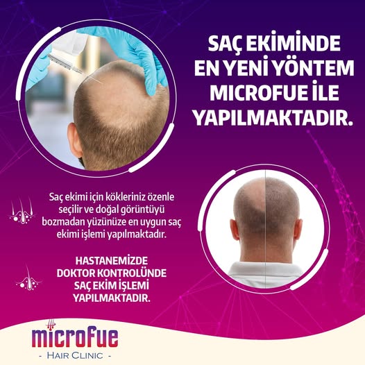 Mikrofue  Hair Klinik yetkilisi  M.Gazi Gökdemir’den Kellik ve tedavi çözümleri   